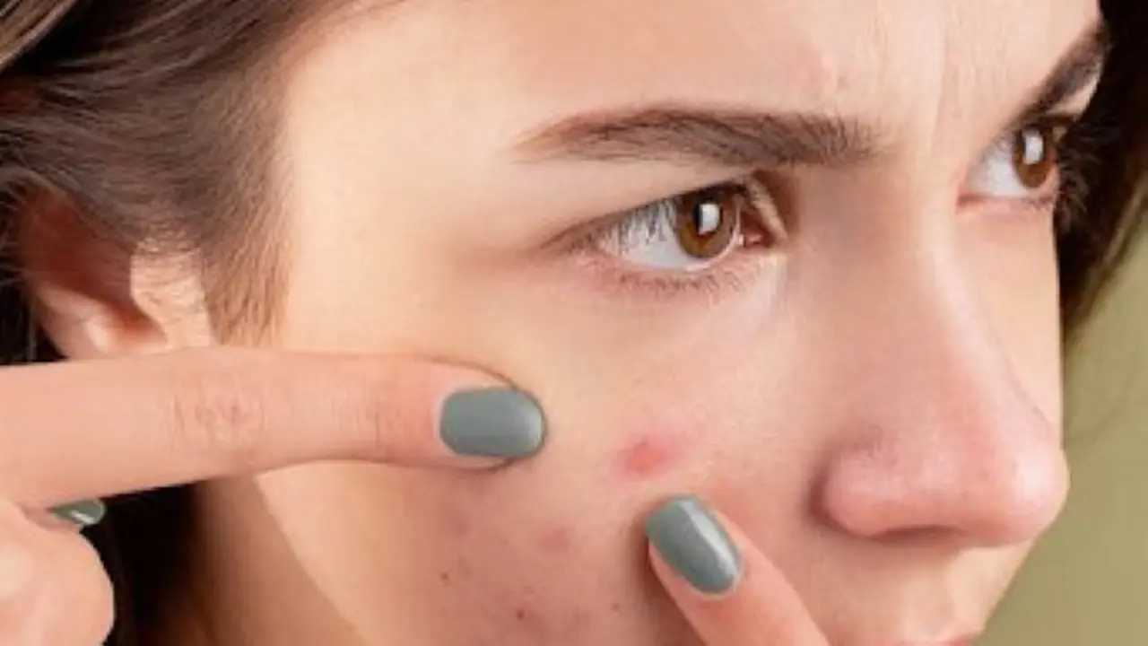 acne 1