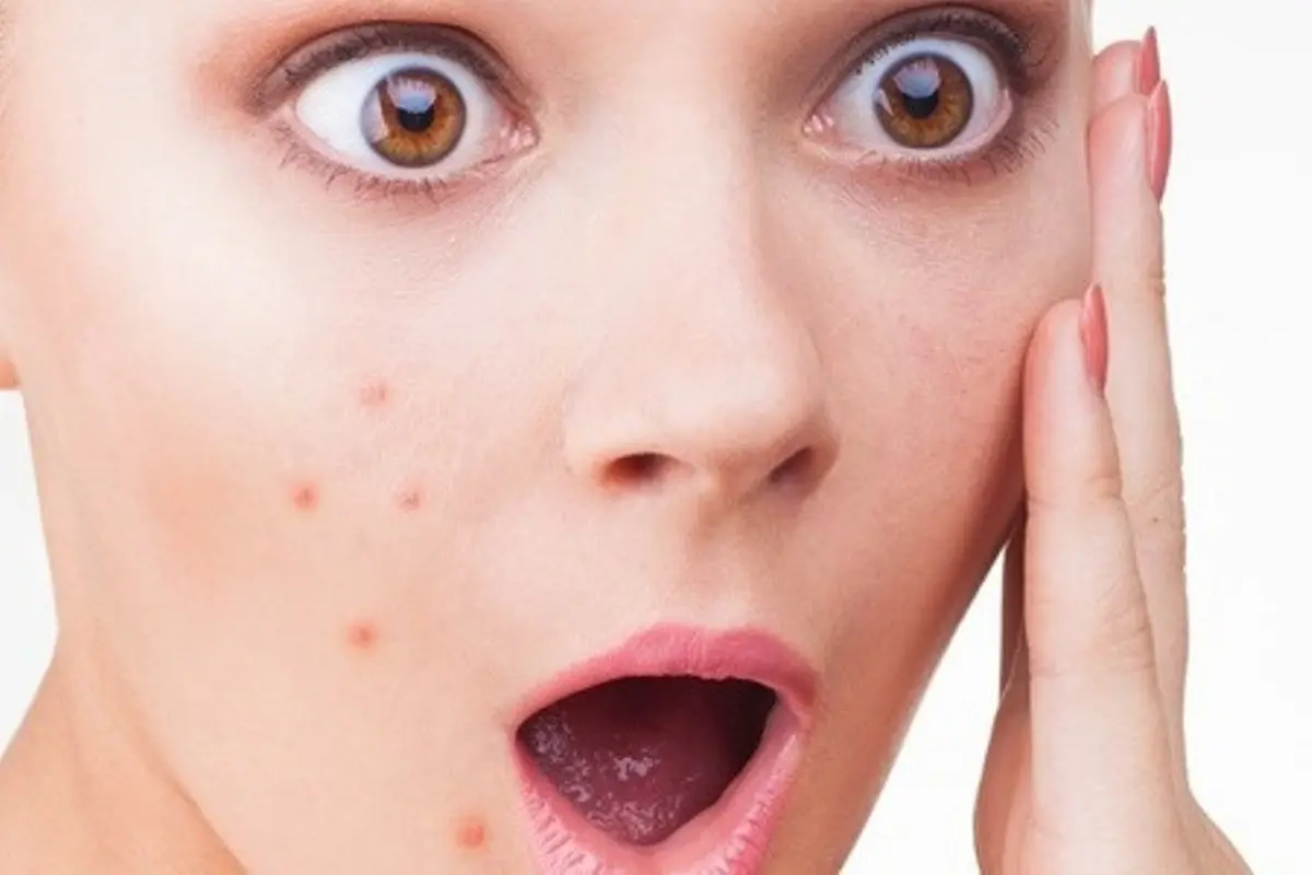 Jangan Minder, Tutupi Bekas Jerawat dengan Makeup Ini Saja