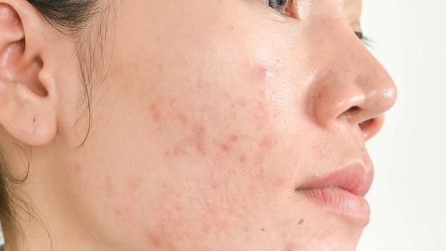 ilustrasi pustula. Sumber: freepik