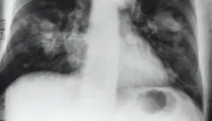 Dokter Ungkap Tantangan Penanganan Kanker Paru di Indonesia
