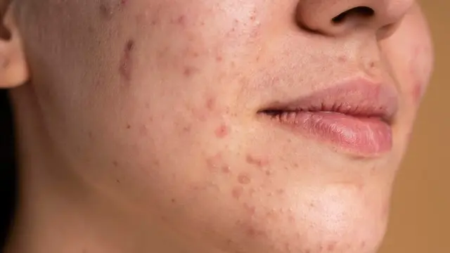 Kondisi Kulit Berjerawat