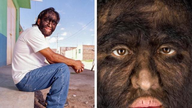 Penyakit Aneh dan Langka di Dunia