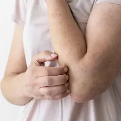 Menyembuhkan Cacar pada Anak agar Cepat Kering dan Tidak Menyebar