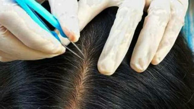 Setop Mencabuti Uban Ini Bahayanya Citizen6 Liputan6 Com