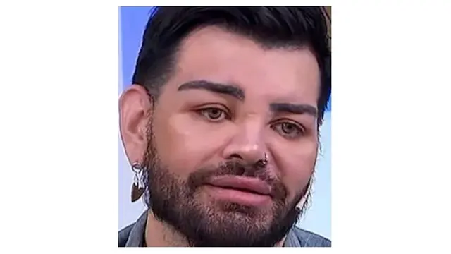 Ingin Mirip Ricky Martin, Pria Ini Lakukan Operasi Plastik hingga 40 Kali