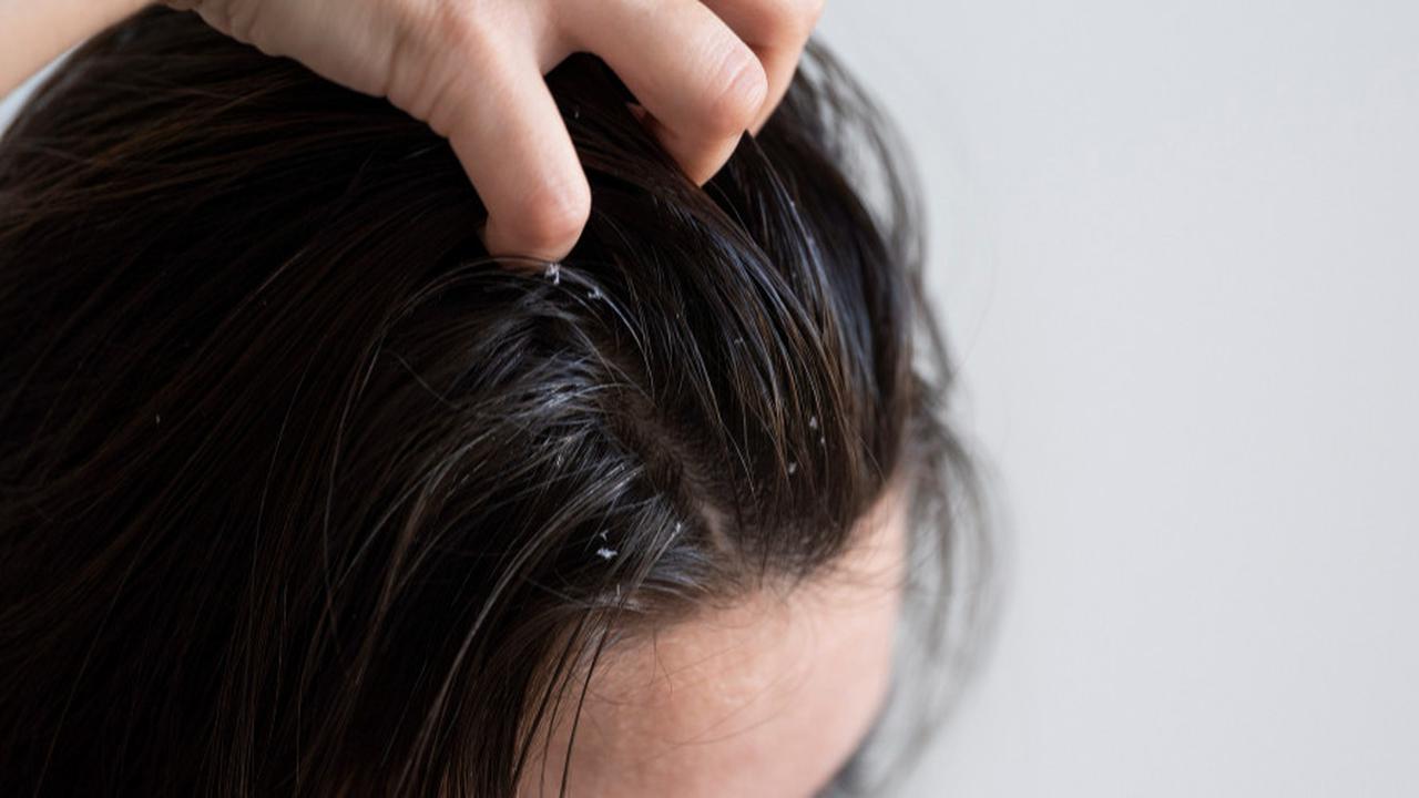 Solusi Praktis untuk Rambut Berminyak dan Lepek
