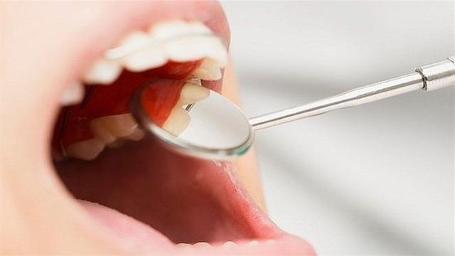 Ilustrasi buka mulut di dokter gigi. Foto: chatelaine