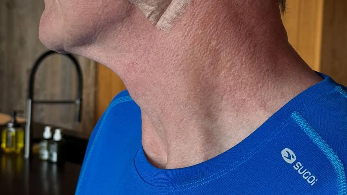 Chef Gordon Ramsay Ungkap Idap Kanker Kulit, Ingatkan Publik Rutin Oles Sunscreen