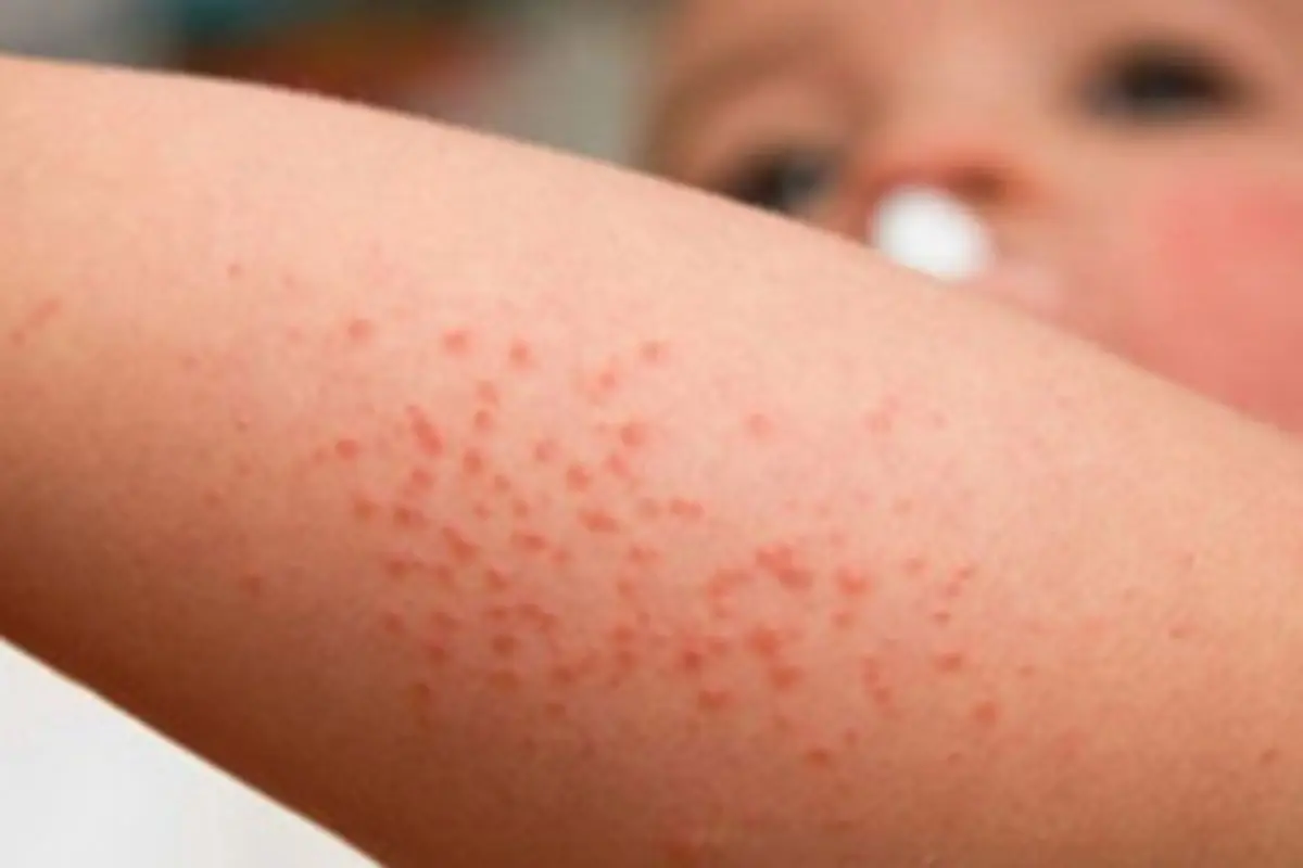 Jaga Kesehatan, Korban Virus Flu Singapura Mulai Berjatuhan