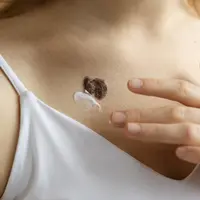 Cara Menghilangkan Keloid Secara Aman