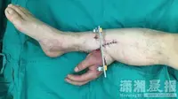 Pasien ini tidak jadi kehilangan tangan kirinya, setelah dokter mencakokkan tangannya pada kakinya selama operasi 