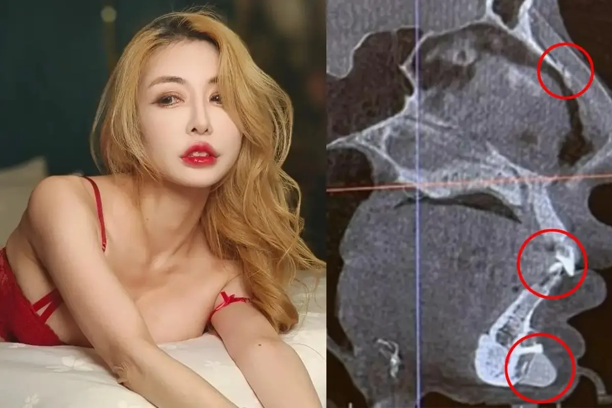 Sekrup Tertinggal di Kulit Wajah Usai Oplas