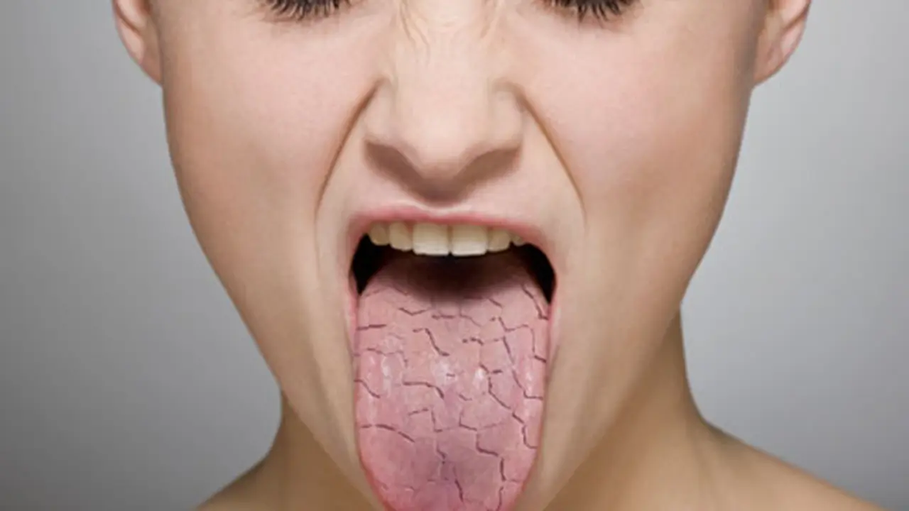 Mulut Kering Pertanda Diabetes?