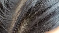 Cara Menghilangkan Telur Kutu Rambut secara Alami dan Permanen