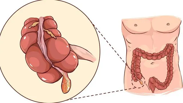 Ilustrasi usus buntu
