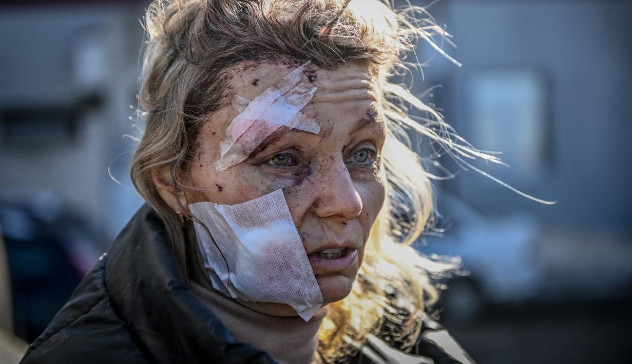Seorang wanita yang terluka berdiri di luar rumah sakit setelah pemboman di Kota Chuguiv, Ukraina timur, 24 Februari 2022. Angkatan bersenjata Rusia mencoba menyerang Ukraina dari beberapa arah, menggunakan sistem roket dan helikopter untuk menyerang posisi Ukraina di selatan. (Aris Messinis/AFP)