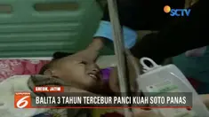 Seorang balita tercebur ke panci isi kuah soto panas saat sang ibu menyusui adik korban.