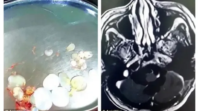 Sering Makan Daging Mentah, 30 Cacing Bersarang Dalam Otak Pria Ini