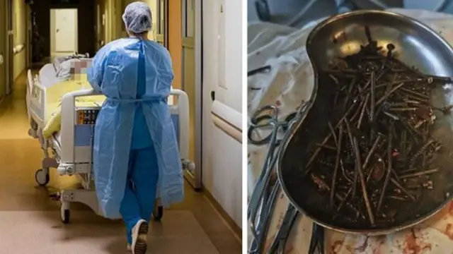 Berhenti Minum Minuman Keras, Perut Pria Ini Malah Dipenuhi 1 Kg Logam
