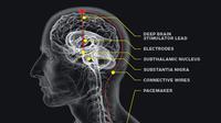 Deep Brain Stimulation merupakan kabar bahagia yang diberikan Rumah Sakit Mount Elizabeth untuk pasien Parkinson.