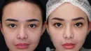Inilah potret perbandingan sebelum dan sesudah Amanda Manopo tarik benang di wajahnya. Perubahan paras wanita keturunan Filipina, Spanyol, dan Minahasa ini sukses bikin pangling. (Liputan6.com/IG/@amandamanopo)
