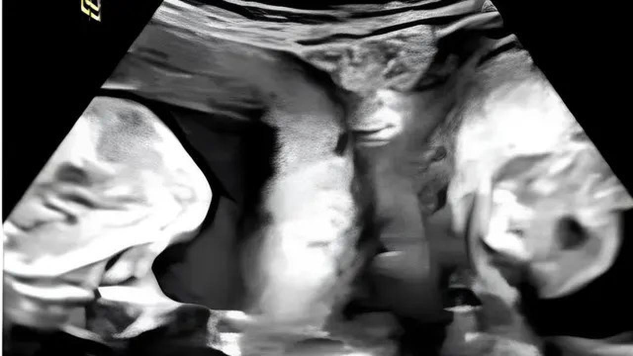 Kisah Wanita Punya Dua Rahim Masing-Masing Mengandung Bayi, Fenomena Langka
