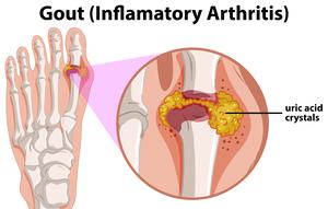 Mengenal Tofi pada Pengidap Asam Urat dan Cara Menanganinya. (Foto: brgfx/Freepik).