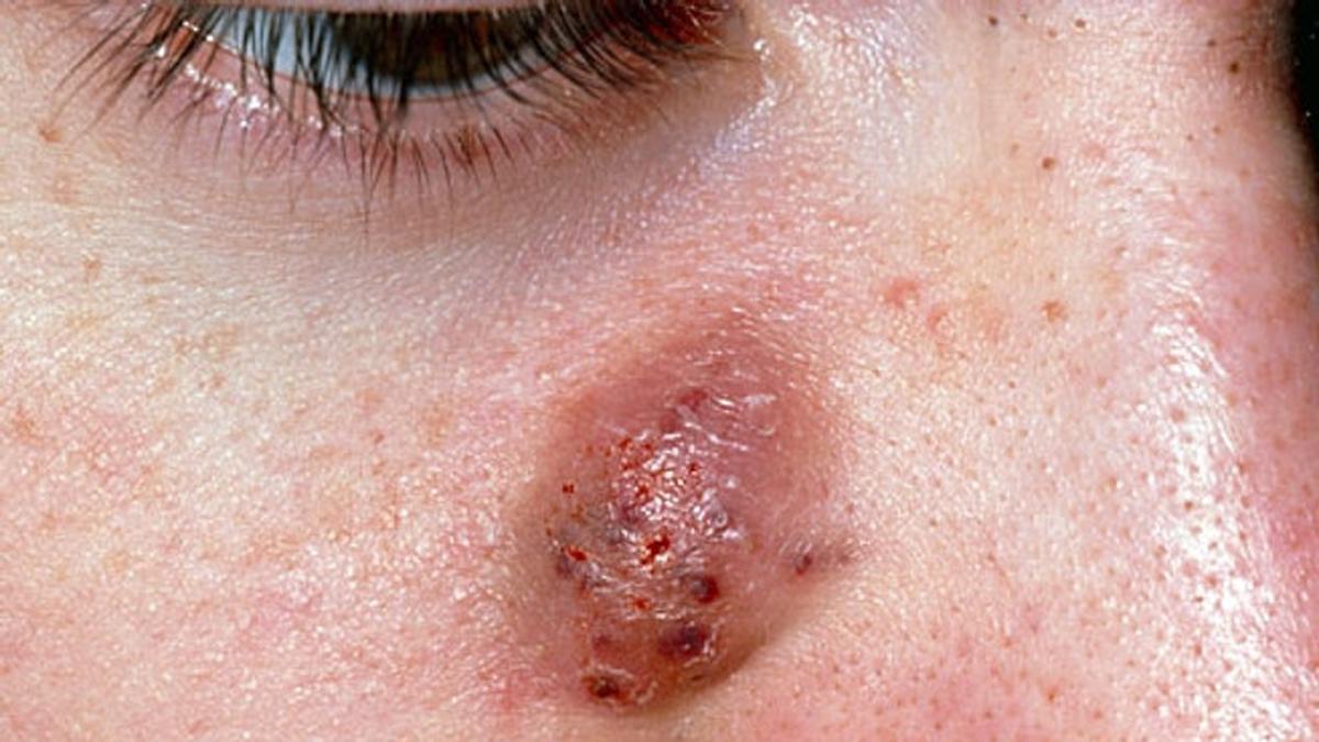 4 Jenis Jerawat yang Sulit Hilang dan Cara Mengatasinya Tanpa Memperparah Kulit