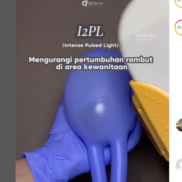 Mengenal Prosedur V-Ning dan P-Rejuve Buat Perawatan Organ Intim Non-invasif