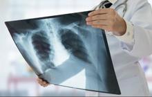 Dokter Spesialis: Lewat Ngobrol, Penderita TBC Aktif Bisa Menularkan ke Lawan Bicara