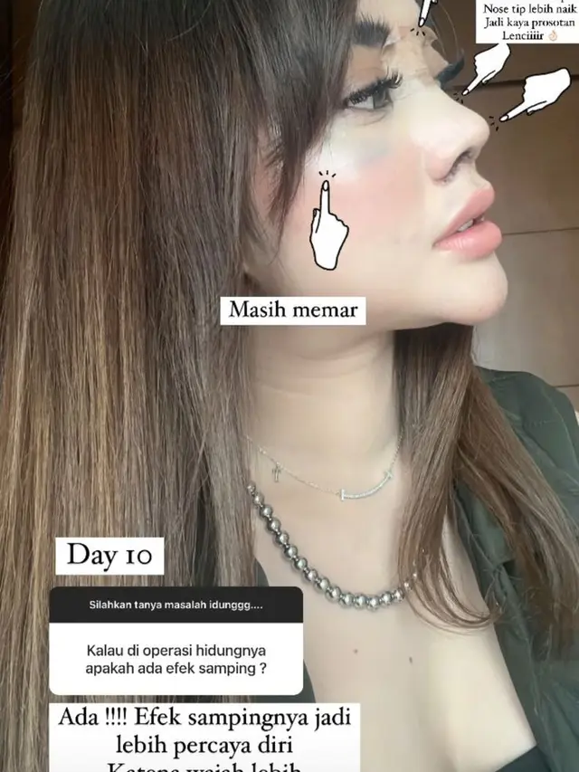 6 Potret Daniar Masterchef Usai Operasi Hidung, Jadi Sorotan