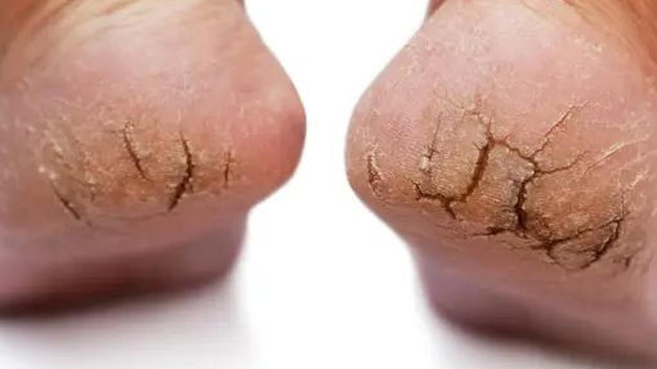 Selain cara-cara di atas, ada juga beberapa bahan alami yang dapat membantu mengatasi kaki pecah-pecah. Berikut adalah 9 bahan alami yang dapat Anda coba: