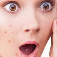 Ilustrasi wajah berjerawat. (via: istimewa)