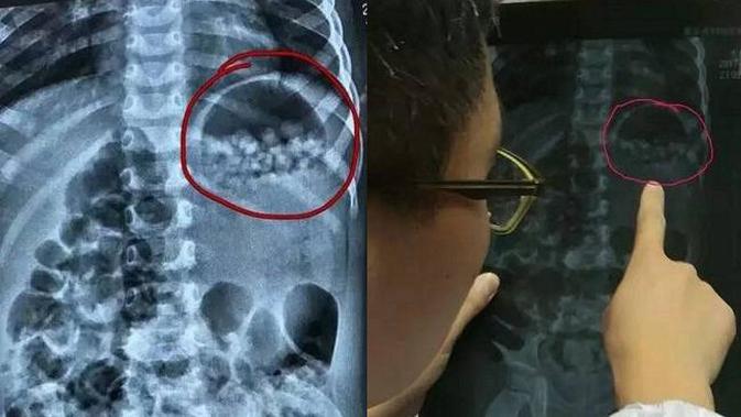 Lambung Anak Ini Dipenuhi 280 Bola Mirip Kelereng Kok Bisa Citizen6 Liputan6 Com