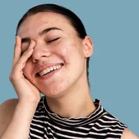 Tips untuk Kulit Berjerawat Tetap Bisa Pakai Makeup (Foto/Sumber: Freepik)
