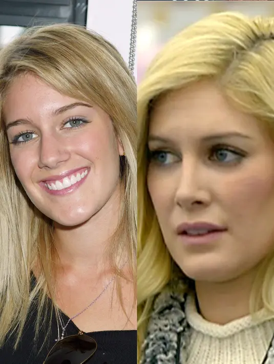 Heidi Montag melakukan 10 rangkaian operasi dalam 1 hari yang hampir membunuhnya. (REX/Shutterstock/HollywoodLife)