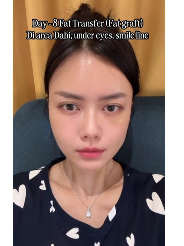 6 Potret Nita Gunawan Jalani Operasi Transfer Lemak ke Wajah Usai BB Turun 10 Kg