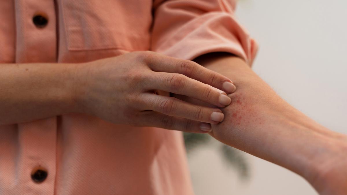 Seasonal Dermatitis: Symptoms, Types & Prevention