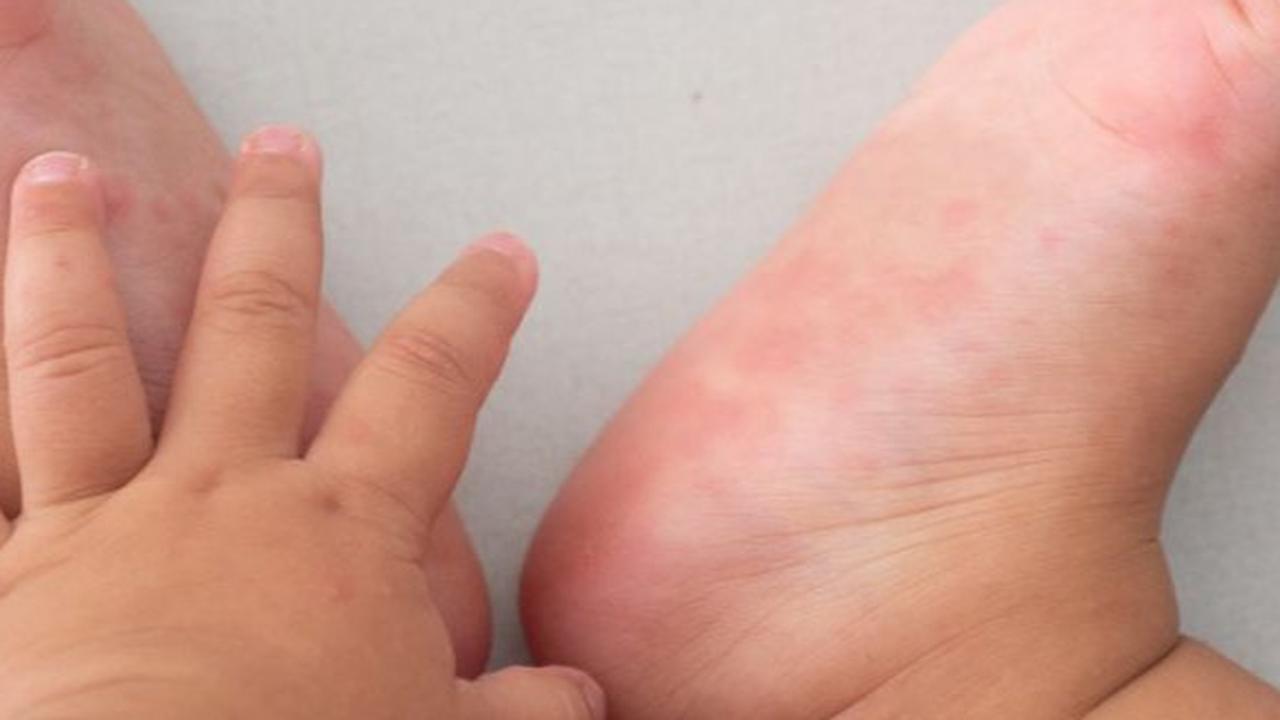 Waspada Penularan Flu Singapura Pada Anak Cenderung Meluas Saat Mudik