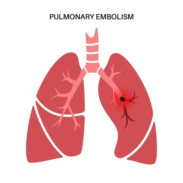 Ilustrasi emboli paru yang terjadi akibat gumpalan darah menyumbat aliran darah ke paru-paru.