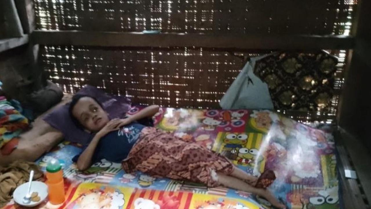 Idap Hidrosefalus Sejak Usia Empat Bulan, Gadis di Lebak Ini Butuh Bantuan untuk Berobat