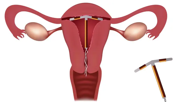 Ahli Kandungan Harus Tahu Cara Pasang Kontrasepsi IUD