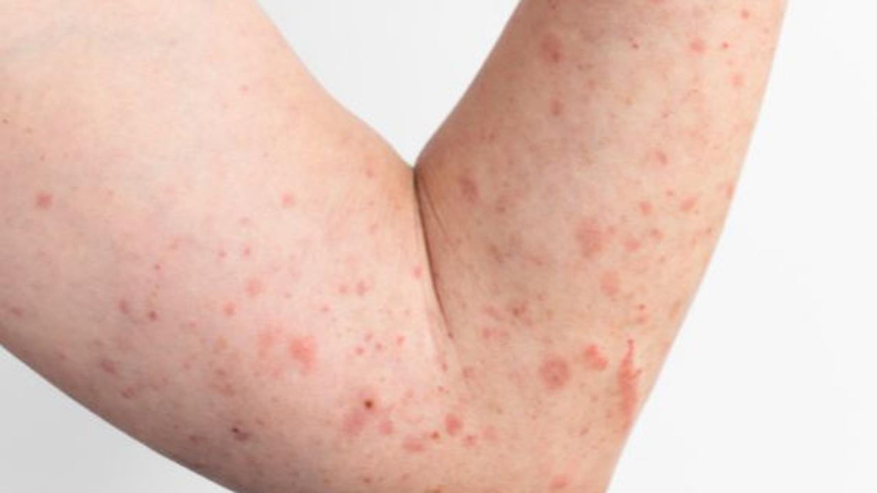 Mpox