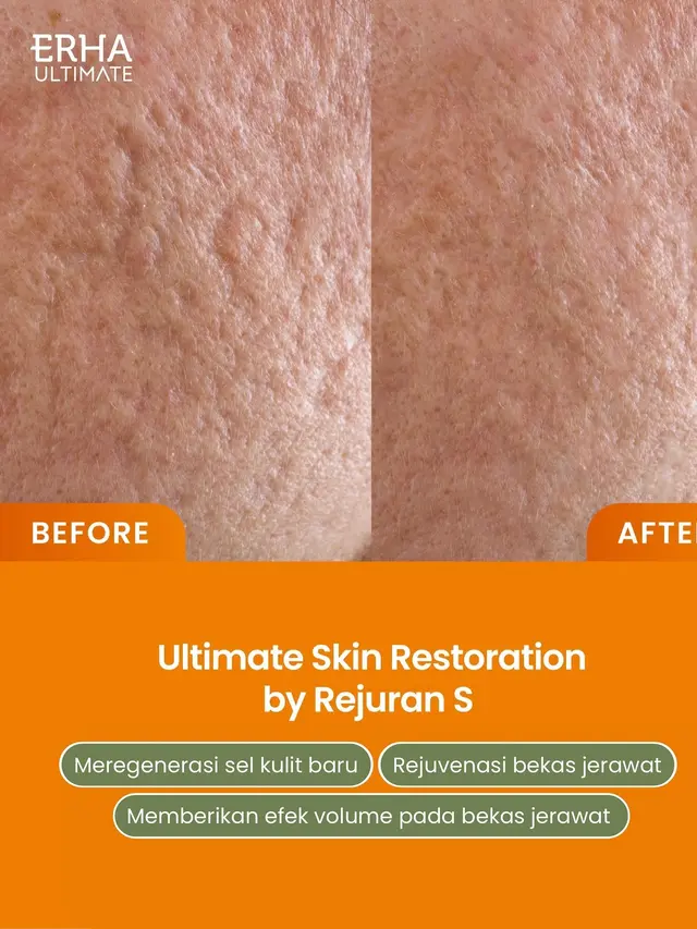 Perawatan Wajah Rejuran Lagi Hits di Korea, Mana Jenis Treatment yang Ingin Kamu Coba?