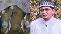 Operasi Bayi Kembar Siam Terkendala Biaya hingga Ustaz Menjawab