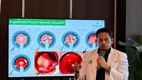 Obat Tetes Bisa Atasi Katarak? Dokter Mata Ungkap Faktanya