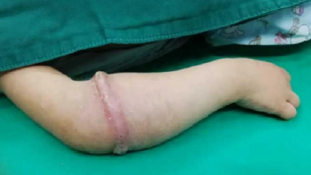 Gunakan Karet Gelang, Balita Justru Alami Bengkak Parah