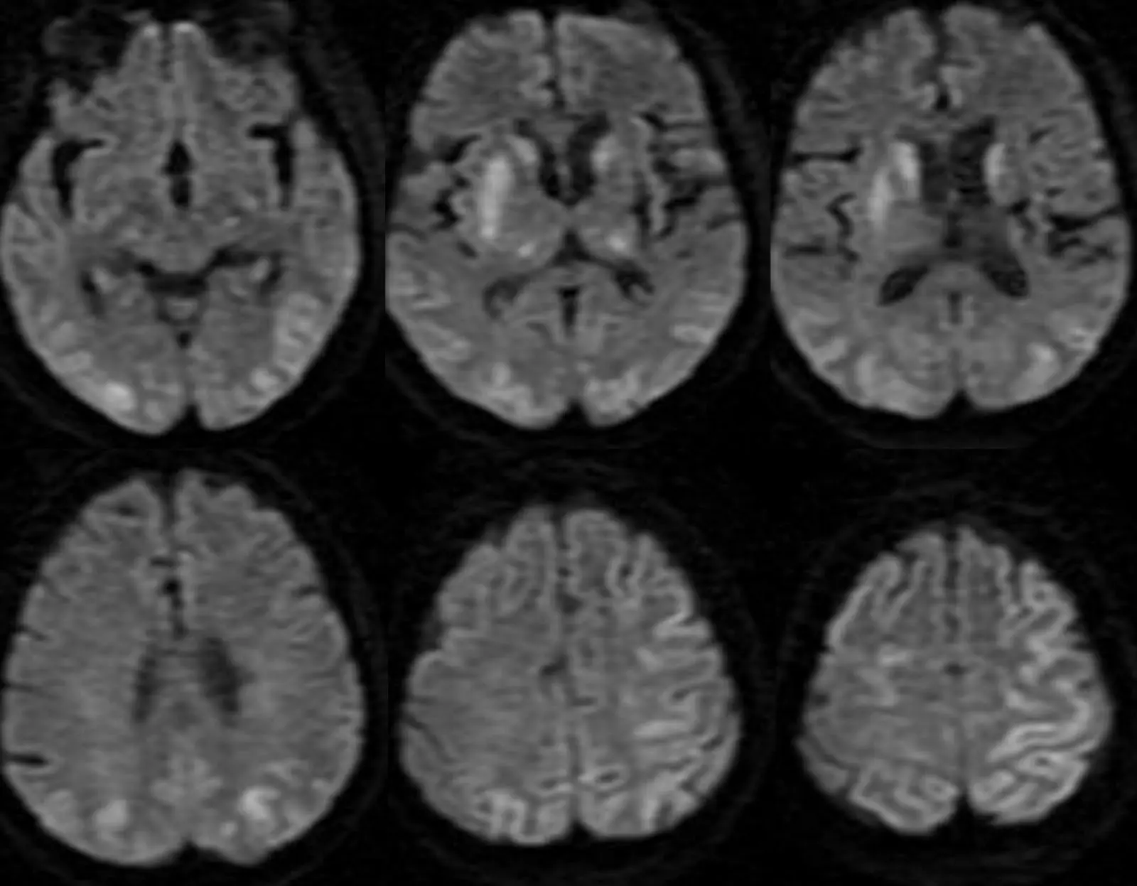 Hypoxia adalah suatu kondisi di mana jaringan tubuh manusia kekurangan oksigen, hal tersebut dapat menyebabkan seseorang yang mengalami hypoxia menjadi kesulitan untuk bernapas. (Foto: neuroradiologycases.com)