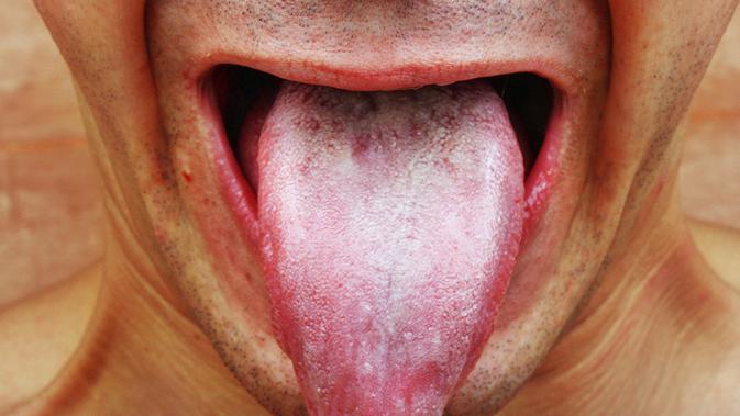 Di Balik Lidah Pasien Demam yang Terasa Pahit Health