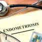 Ilustrasi Endometriosis (Foto: iStockphoto)